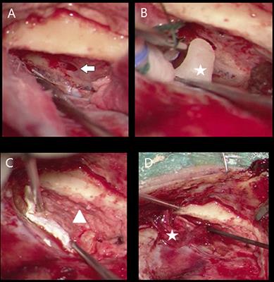 Management and Outcomes of Spontaneous Cerebrospinal Fluid Otorrhoea